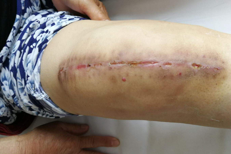 伤口钢板排异图