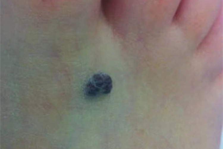 蓝色橡皮疱样痣脚背有蓝疙瘩图