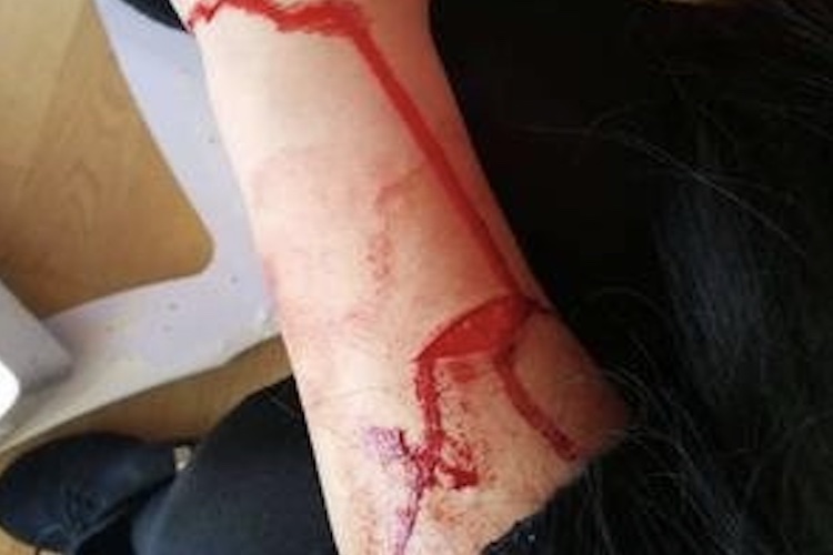 胳膊划上开放性损伤图