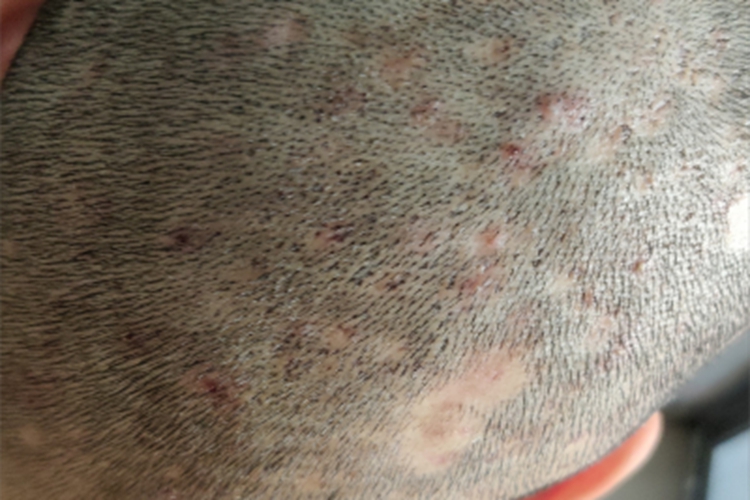 马拉色菌毛囊炎头皮疙瘩图 马拉色菌毛囊炎头皮疙瘩图