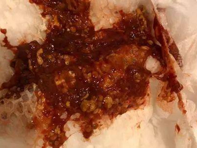 肠炭疽血样便图