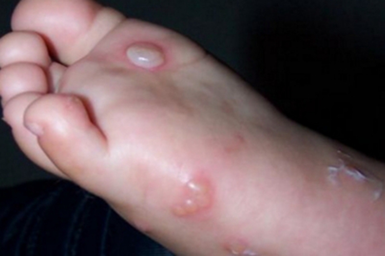 婴儿肢端脓疱病脚底水疱图