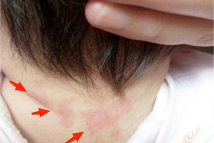 柯萨奇湿疹脖子后有红斑图