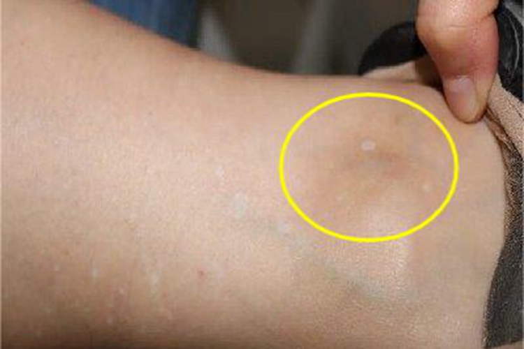 特发性点状色素减退斑脚踝症状图