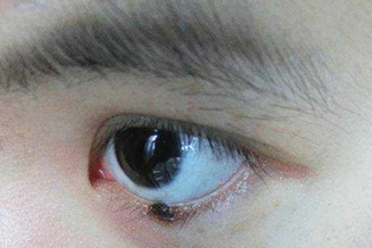 恶性黑色素瘤眼睑症状图