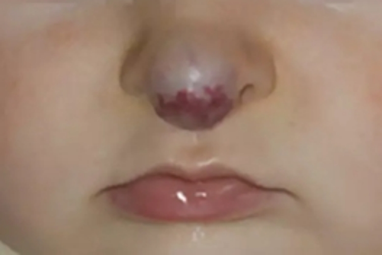 小儿血管瘤鼻尖草莓样疙瘩图