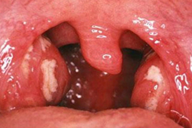 急性扁桃体炎扁桃体有白色渗出图 急性扁桃体炎扁桃体有白色渗出图
