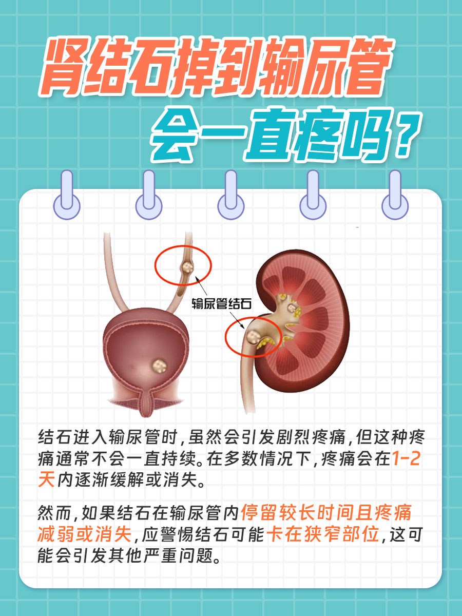 揭秘！肾结石掉到输尿管会一直疼吗