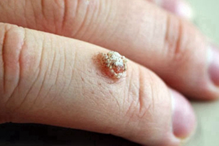 寻常疣样职业性疣赘手指赘生物图 寻常疣样职业性疣赘手指赘生物图