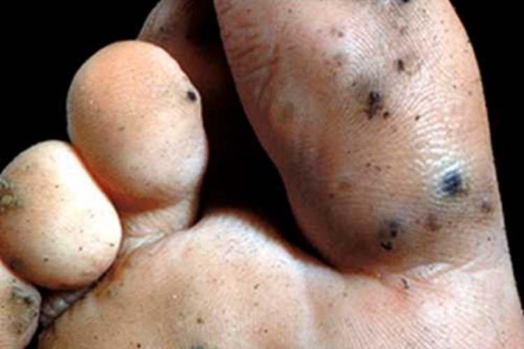 血管角化瘤脚趾疙瘩图