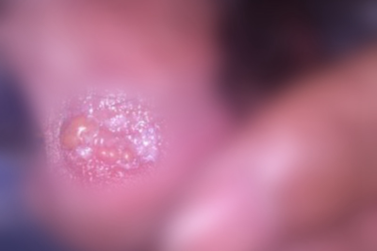 男性生殖器疱疹小水疱图 男性生殖器疱疹小水疱图