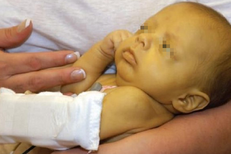 婴儿病理性黄疸皮肤暗黄图