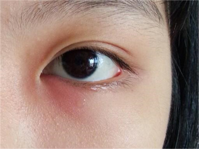 眦角性睑缘炎左眼角皮肤发红图