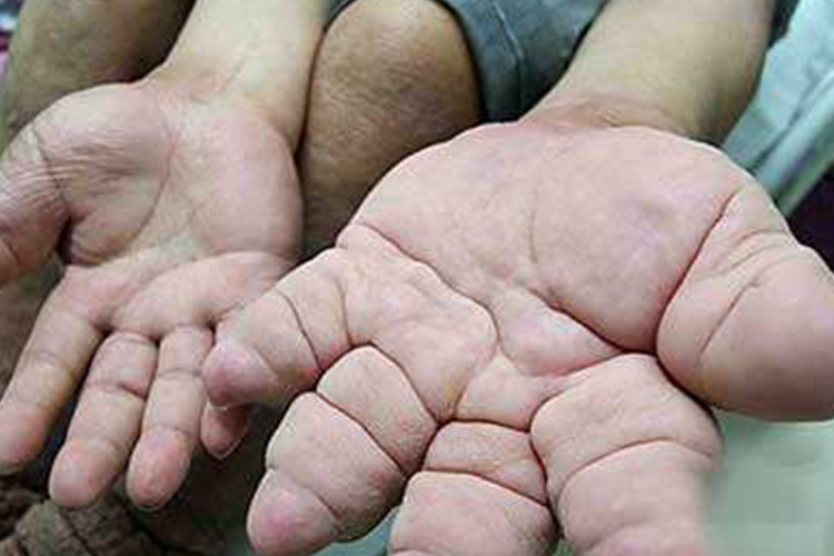 甲状旁腺机能亢进引起的指尖短宽图