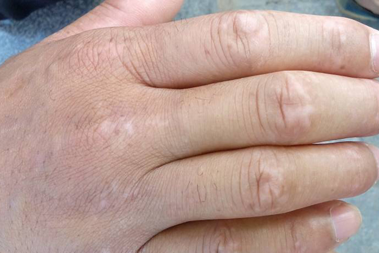 手部贫血痣图