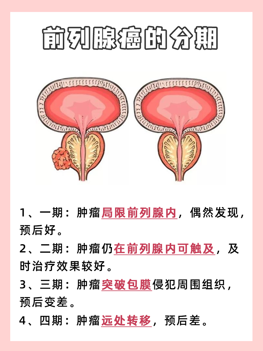 你了解前列腺癌的分期吗？一文读懂