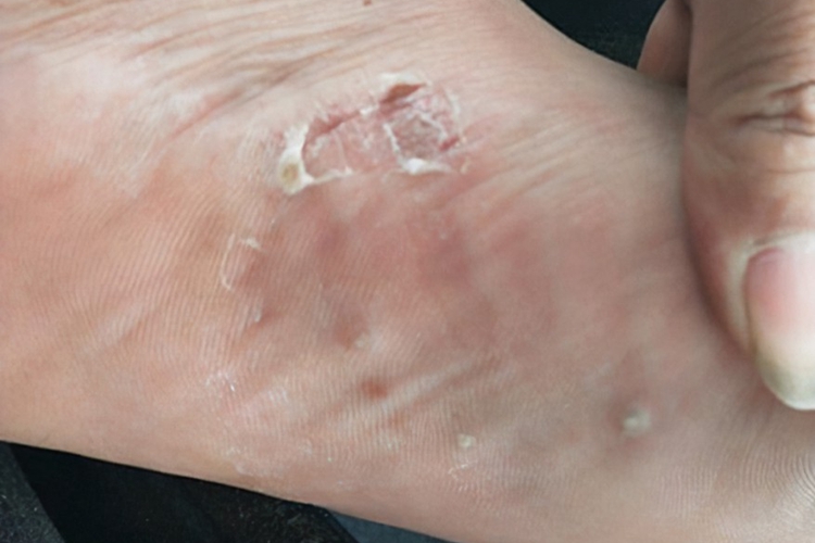 脚底亚急性湿疹图