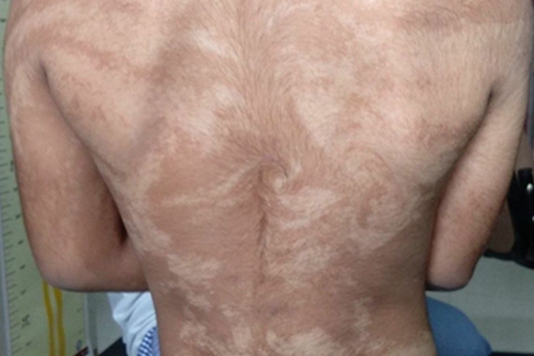 脱色性色素失禁症背部条纹图 脱色性色素失禁症背部条纹图