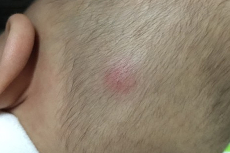 虫咬皮炎头皮红疙瘩图