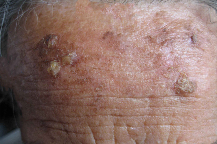 日光性角化病前额症状图