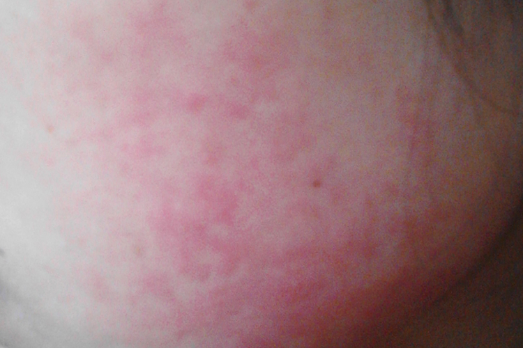 珍珠过敏症状图