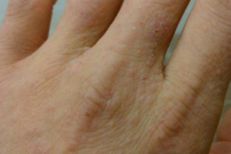 手部湿疹手背长疙瘩痒图