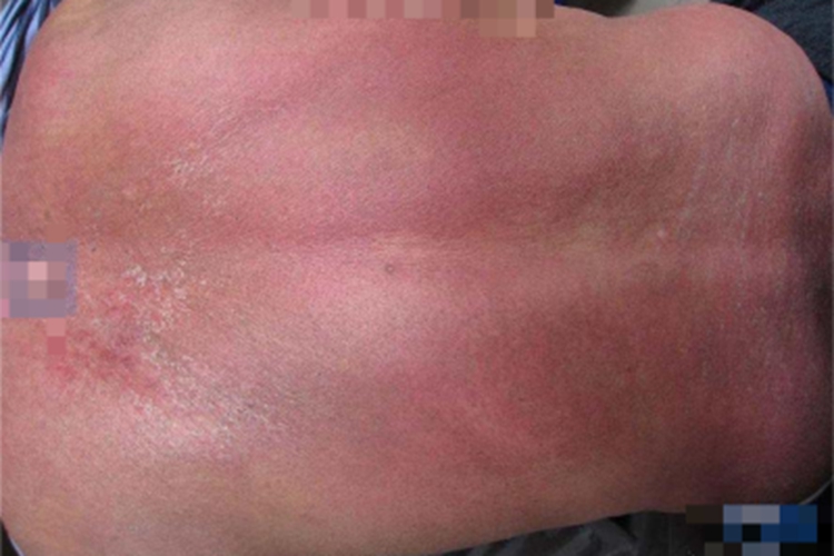 血管萎缩性皮肤异色病背部症状图