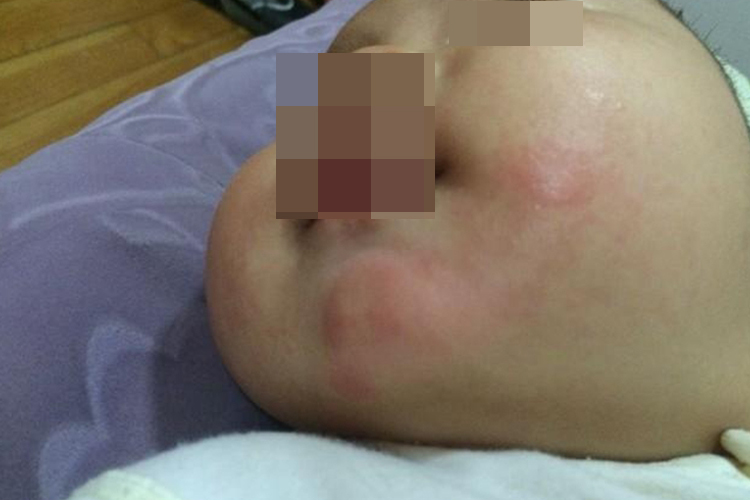 急性自发性荨麻疹下巴红图 急性自发性荨麻疹下巴红图