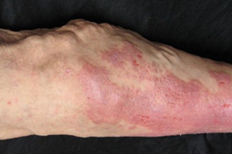 淤积性皮炎结节图