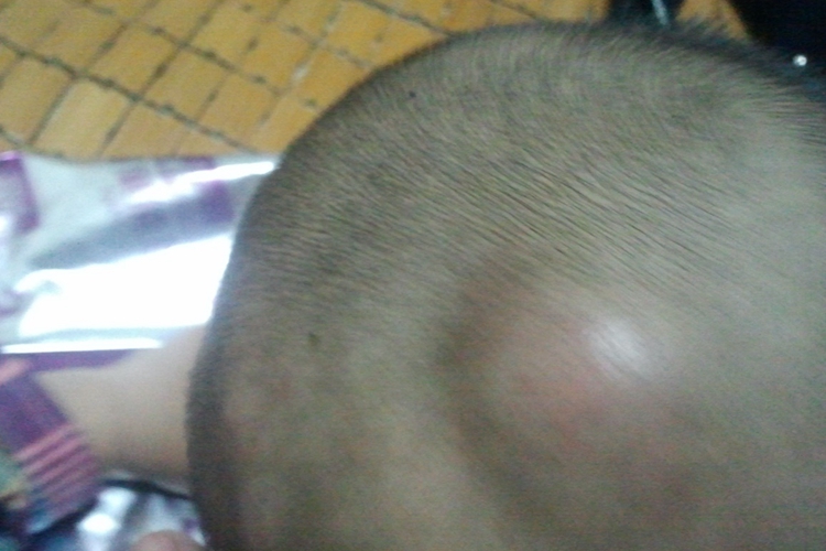 宝宝摔到头头皮下血肿侧面鼓软包图 宝宝摔到头头皮下血肿侧面鼓软包图