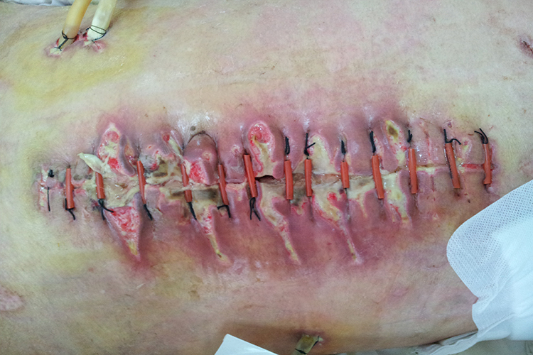 切口愈合不良图 切口愈合不良图