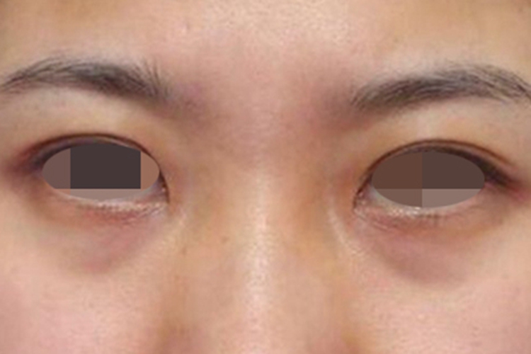 眶周色素沉着症眼睑斑图 眶周色素沉着症眼睑斑图