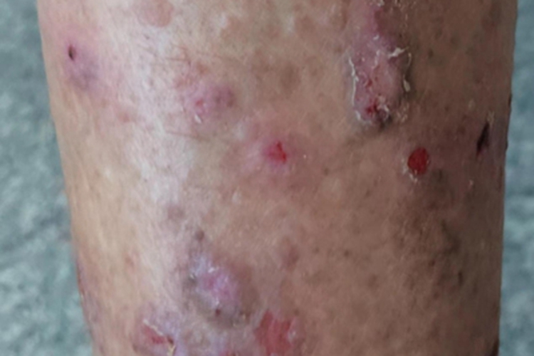 痒疹皮肤糜烂图