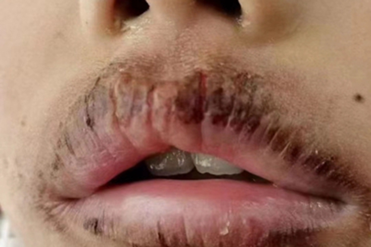 剥脱性唇炎嘴唇结痂图