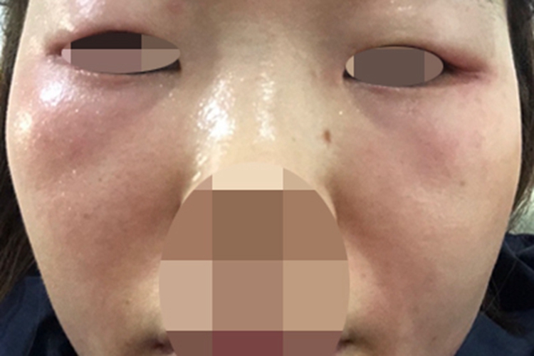 糖皮质激素依赖性皮炎红肿图