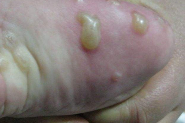 水疱型足癣图 水疱型足癣图