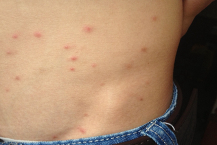 地方性斑疹伤寒腹部症状图