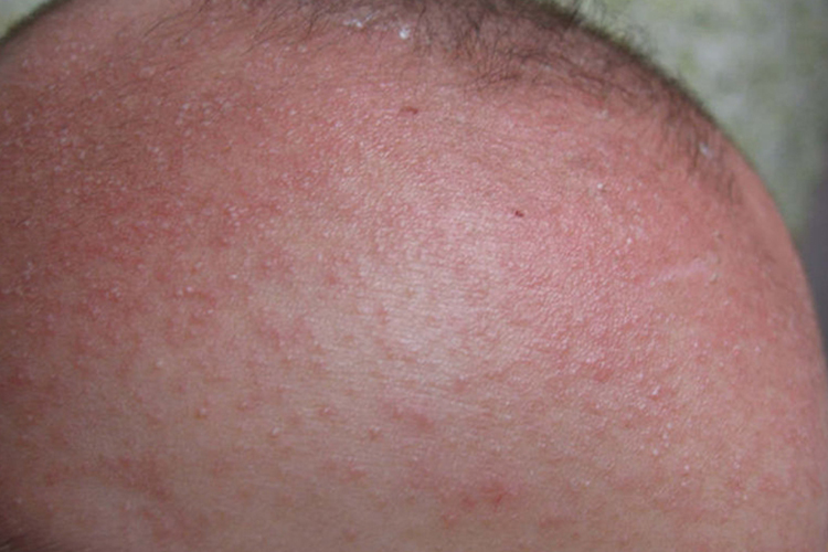 脓疱性粟丘疹图