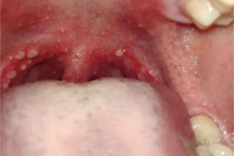 溃疡性皮肤结核口腔溃疡图