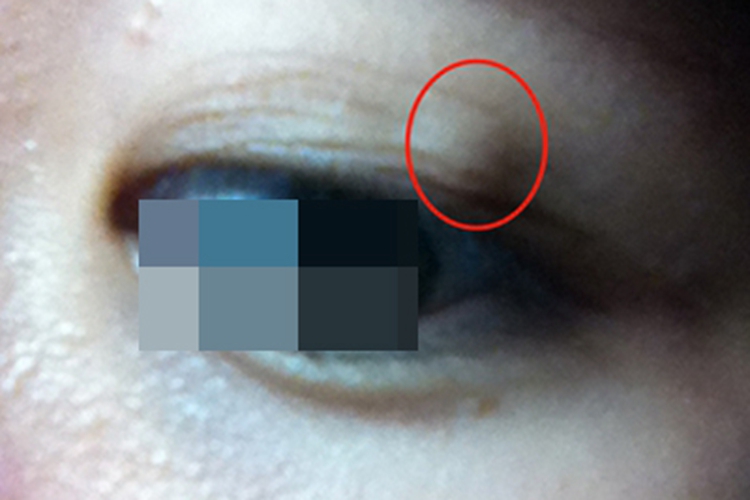 皮样囊肿上眼皮小肿块图