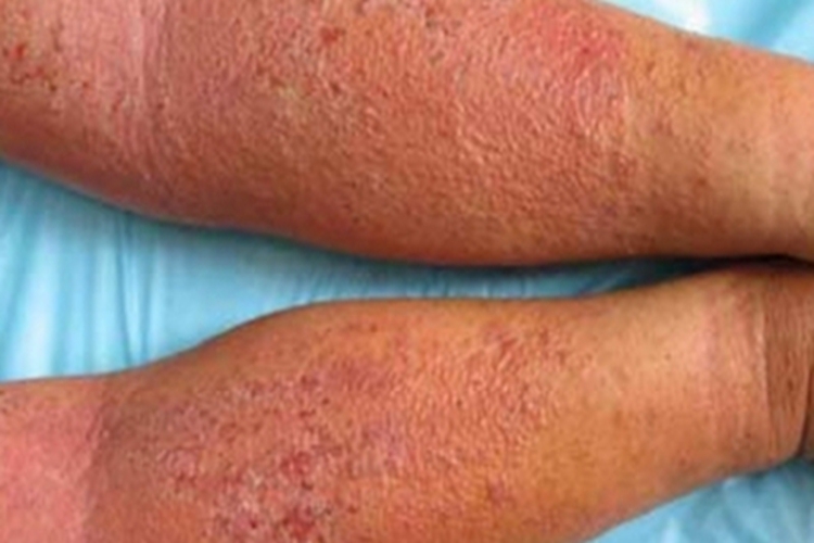 大疱性表皮松解症胳膊症状图