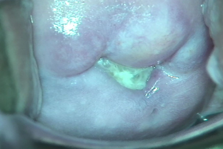 滴虫性阴道炎白带泡沫状图