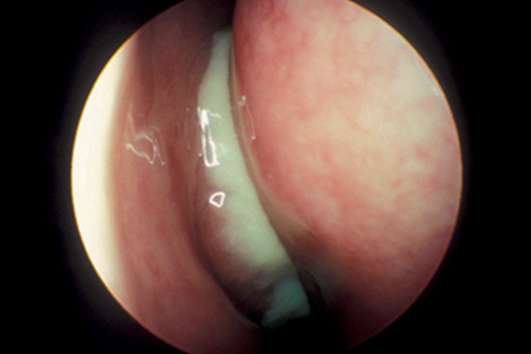 慢性化脓性鼻窦炎鼻腔症状图