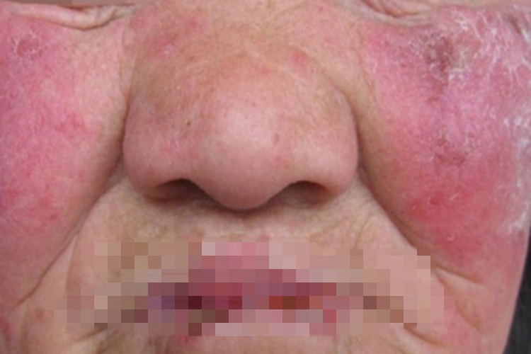 盘状红斑狼疮面部出现红斑图