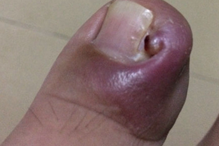 嵌甲脚趾甲化脓图
