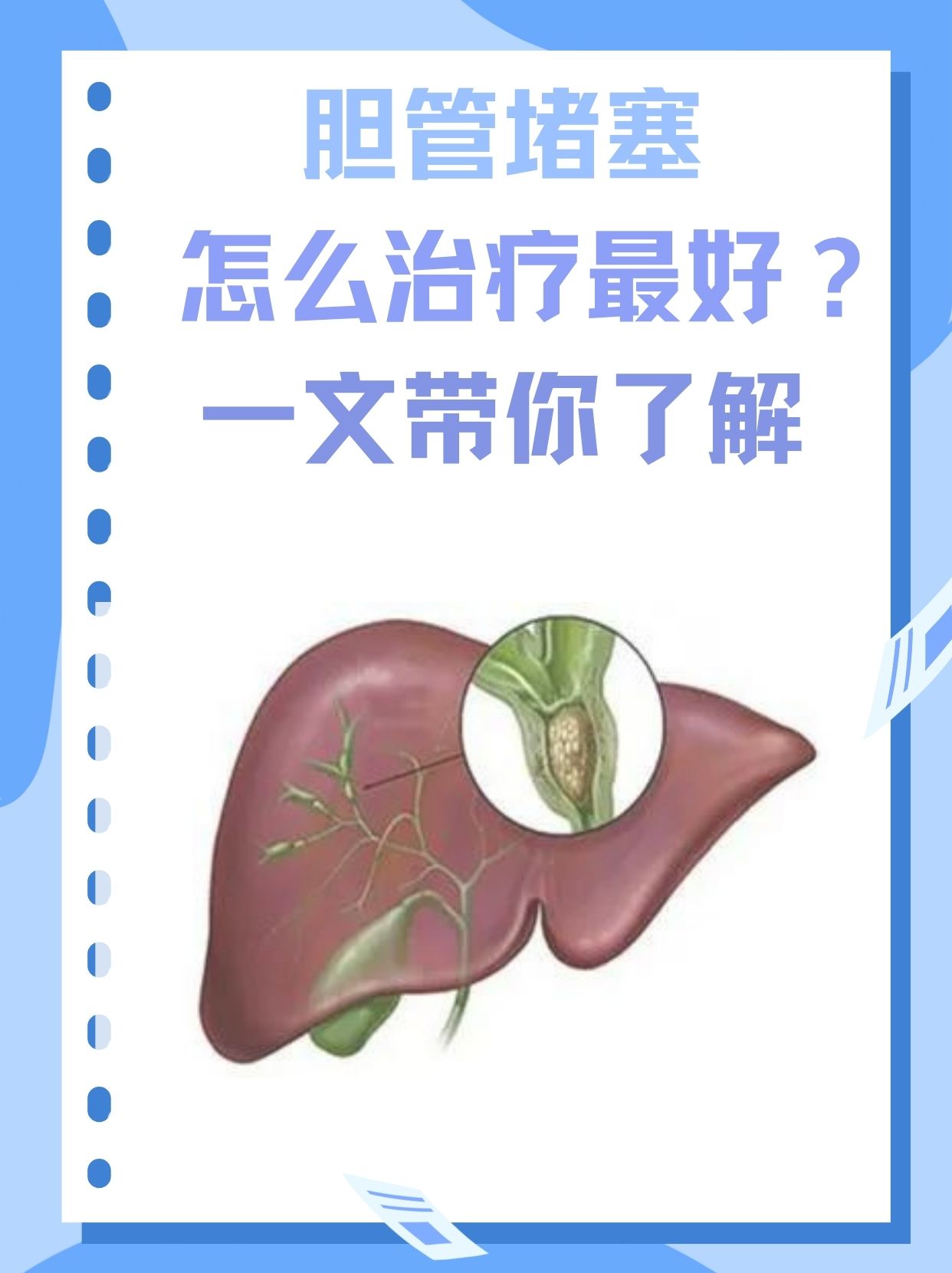 胆管堵塞怎么治疗最好？一文带你了解