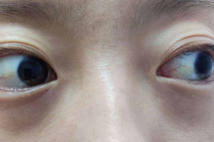 黄疸早期出现的部位图-面部黄疸 黄疸早期出现的部位图-面部黄疸