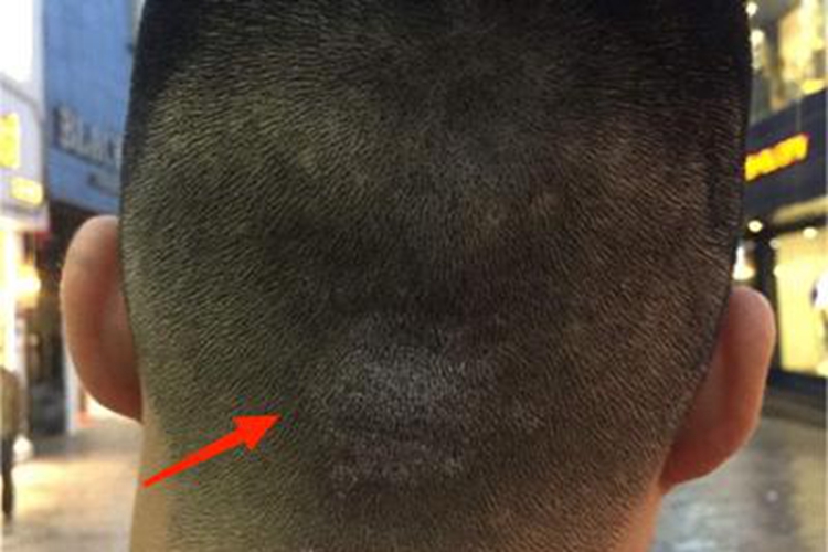 头皮糠疹头皮白色结痂图