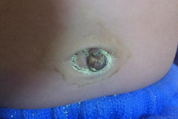 毛发肉芽肿肚脐化脓图