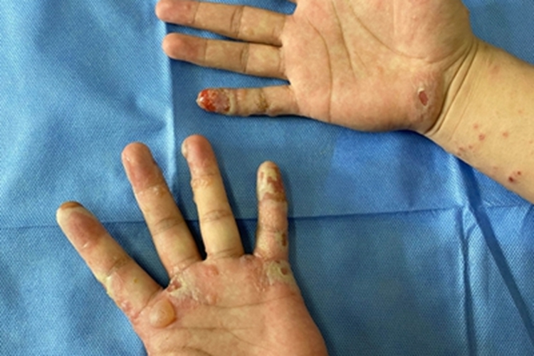 非大疱型脓疱疮手掌丘疹图 非大疱型脓疱疮手掌丘疹图